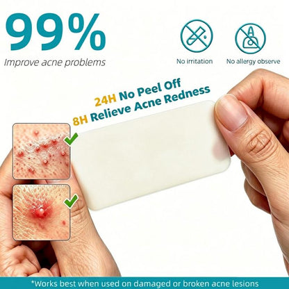 Dimora Medical-Grade Hydrocolloid Acne Patch, Acne spot treatment, Cuttable Overnight Pimple Patch, Acne Mark Fading Patch, Large Size Roll (2 in × 16 ft), Suitable for Acne, Open Wounds, and Sensitive Skin