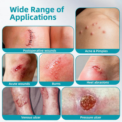 Dimora Medical-Grade Hydrocolloid Acne Patch, Acne spot treatment, Cuttable Overnight Pimple Patch, Acne Mark Fading Patch, Large Size Roll (2 in × 16 ft), Suitable for Acne, Open Wounds, and Sensitive Skin